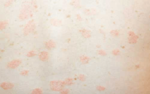 Розовый псевдолишай Жибера при коронавирусе